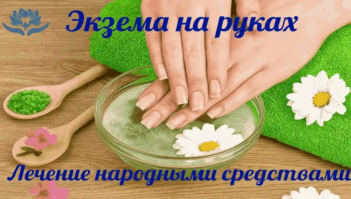 Экзема рук — эффективные народные средства Экзема рук — лечение народными средствами